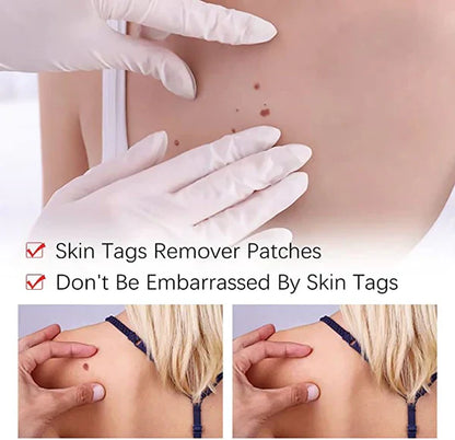 Tags & Moles Remover